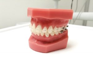 frenillos-zafiro-clinica-dental-amanda