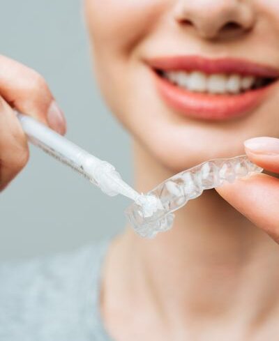 Blanqueamiento dental - clinica dental amanda (7)