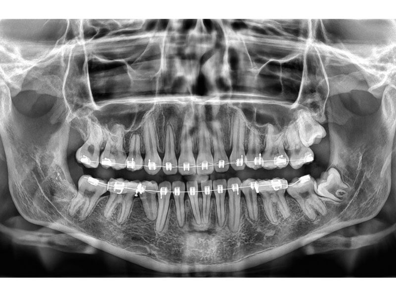 Radiografía Panorámica con Brackets Dentales